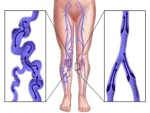 Comparación de venas afectadas por varicosa y venas después de usar Veniselle