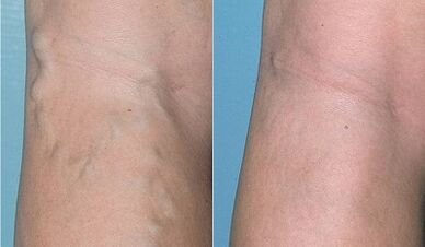 Cómo tratar las venas varicosas en las piernas