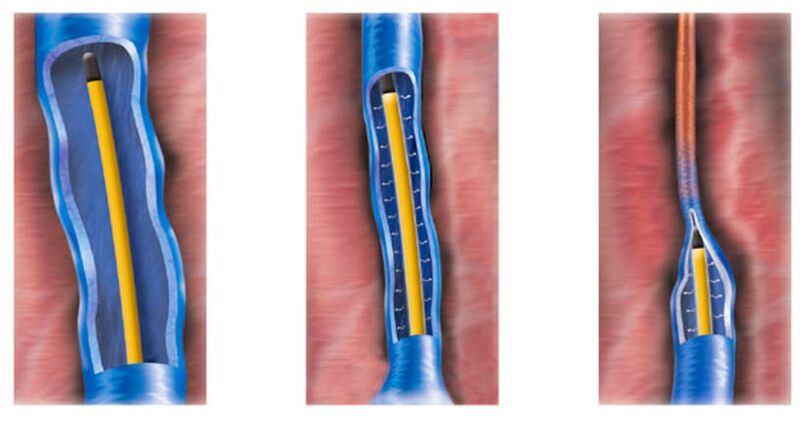 La ablación por radiofrecuencia como método para tratar las venas varicosas.