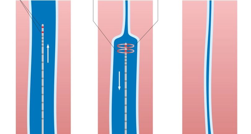 Tratamiento con láser para las venas varicosas en las piernas.